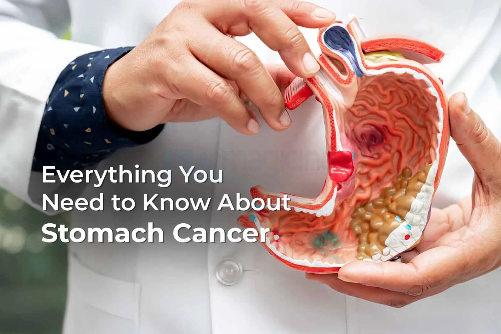 Understanding Stomach Cancer: Causes, Symptoms, Types, Diagnosis & Treatments