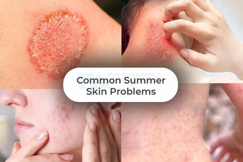 Common Summer Skin Problems: Know about their Solutions and Prevention Common Summer Skin Problems: Know about their Solutions and Prevention
